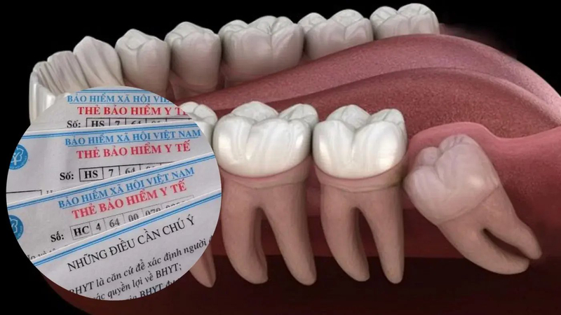 Giá nhổ răng khôn bảo hiểm y tế? Chi phí nhổ răng khôn có được hưởng bảo hiểm y tế không?